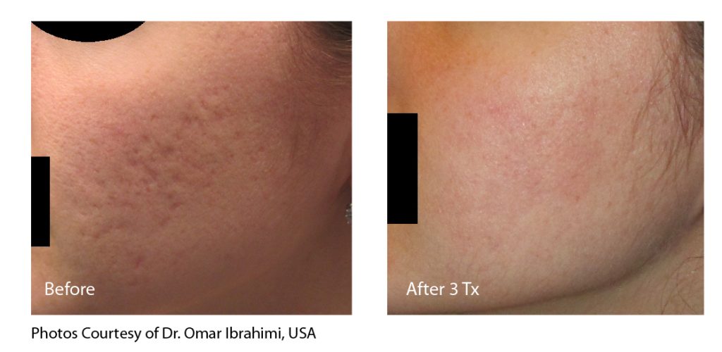 acne scars before and after laguna beach