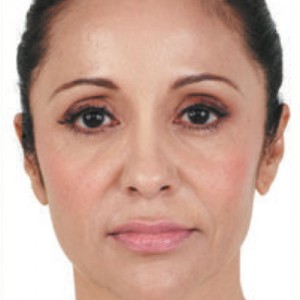 restylane facial filler injection results in laguna beach, ca