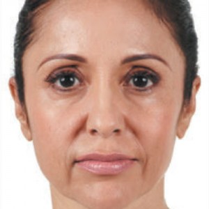 a patient headshot before receiving facial filler injections in Laguna Beach, CA