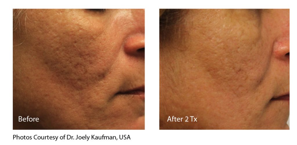 acne scars treatment results shared by Dr. Goldberg in Laguna Beach, CA