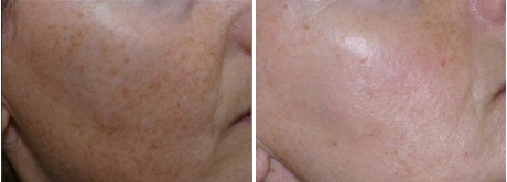 before and after results from an IPL laser treatment in Laguna Beach, CA