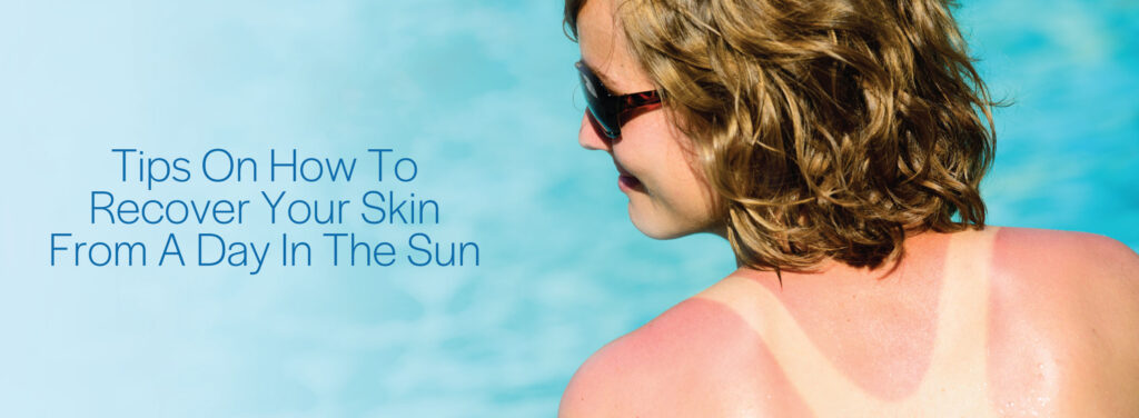 sunburn recovery tips
