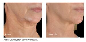 before and after results of a RF microneedling treatment shared by Coast Dermatology in Laguna Beach, CA
