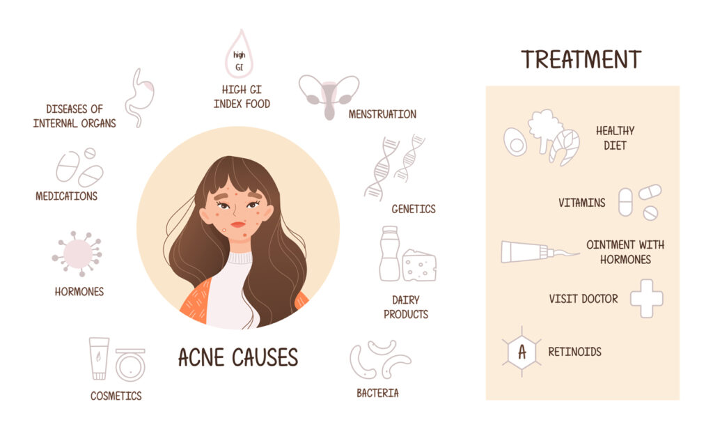 acne treatment and prevention tips